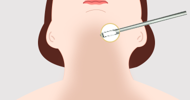 피부 근육 사이 지방을 흡입하는 과정