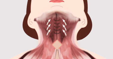 활경근을 절개하여 목과 턱의 경계를 만드는 과정