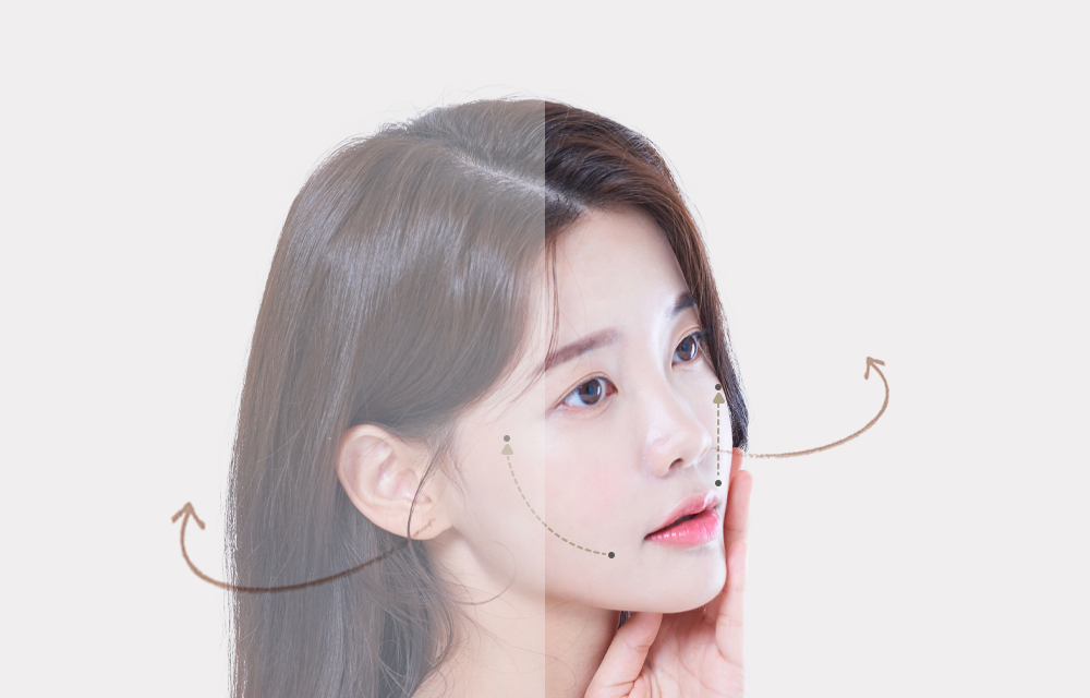 기존 사선 방향 리프팅과 올하트 수직 방향 리프팅의 당김 방향을 비교한 얼굴 이미지