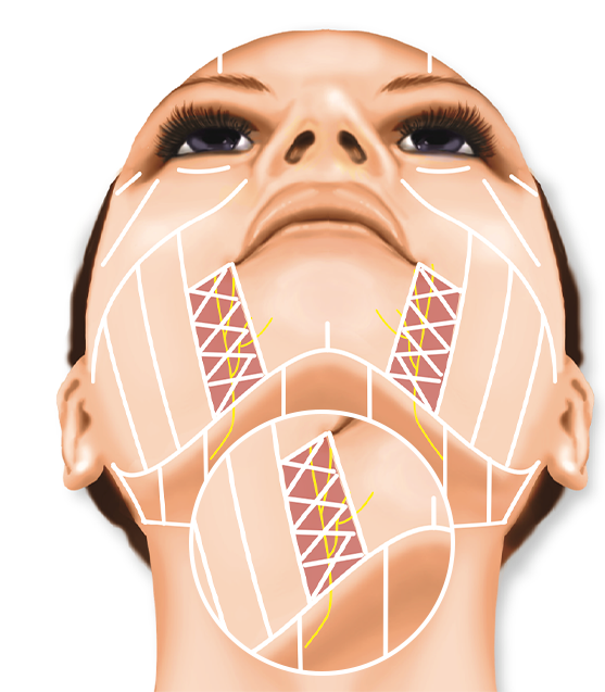 얼굴 정면 하부에서 부위별 시술 범위를 세밀하게 나눈 울쎄라 디자인 차트