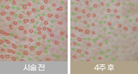 리쥬란힐러 시술 후 피부 수분량 증가와 모공 축소 효과를 비교한 자료