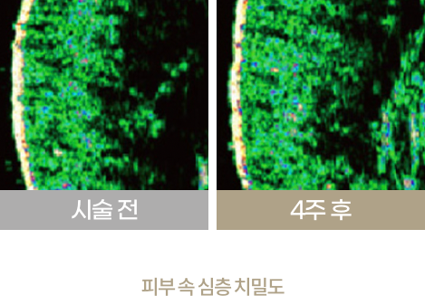 리쥬란힐러 시술 전후 진피층 두께 개선 수치와 피부 속 신생세포를 비교한 자료