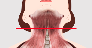 활경근 교차 정도 TYPE B
