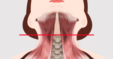 활경근 교차 정도 TYPE C