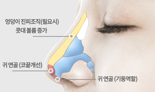 귀 연골을 이용해 코 기둥과 코끝을 교정하는 코성형 구조 이미지
