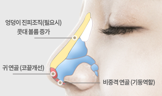 비중격 연골로 코 기둥을 세우고 귀 연골로 코끝을 교정하는 코성형 구조 이미지