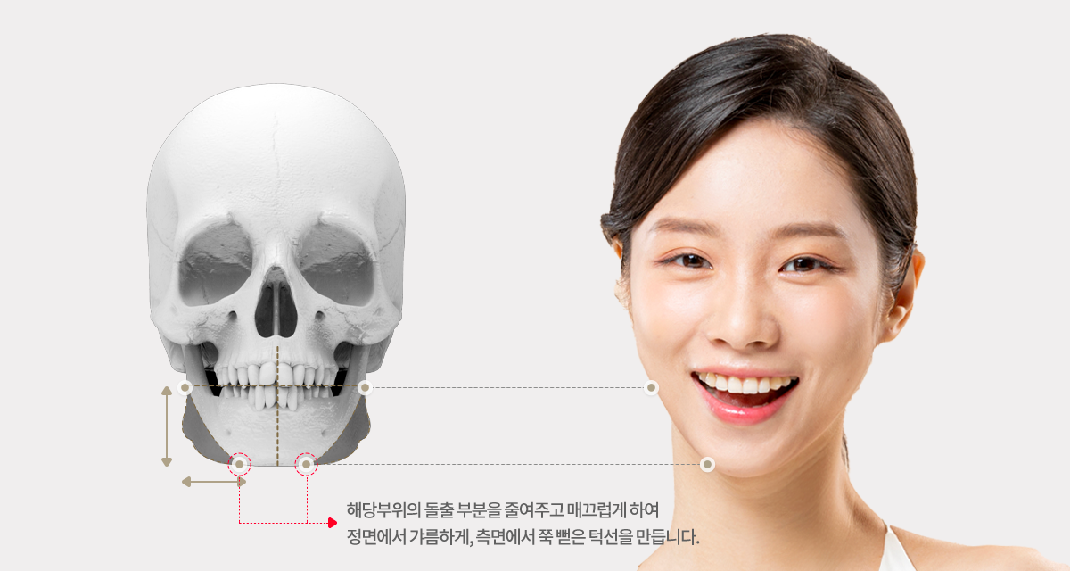 신경선 위치를 고려해 턱끝 뼈 절제선을 연결하는 턱끝성형술 설명 이미지