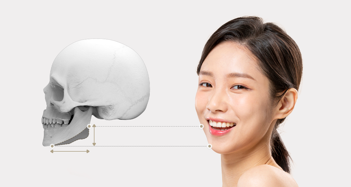 사각턱과 턱끝의 길이 및 비율을 고려한 V라인 윤곽수술 설명 이미지