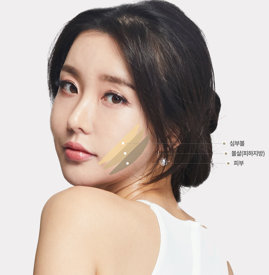 심부볼과 볼살 지방 제거 부위를 설명하는 이미지