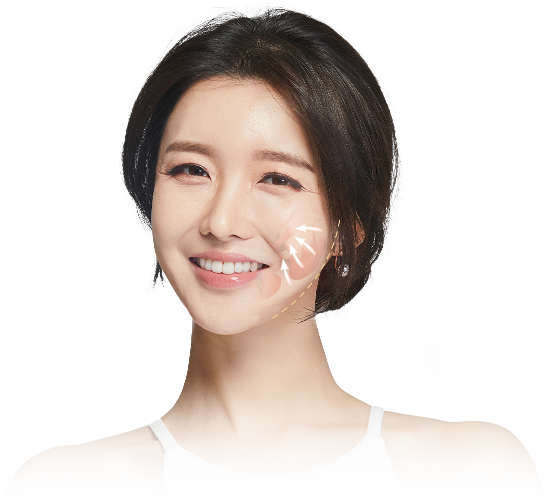 발달한 교근을 선택적으로 축소하는 방법을 설명하는 이미지