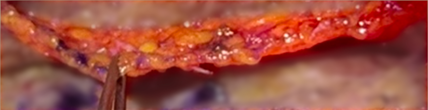균일하게 박리된 SMAS층