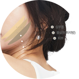 심부볼과 얼굴 지방 제거 부위 이미지