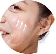 광대뼈 안쪽에 위치한 심부볼 지방을 제거 경우 이미지