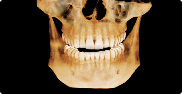 안면윤곽 재수술 전 3D CT 정면 이미지