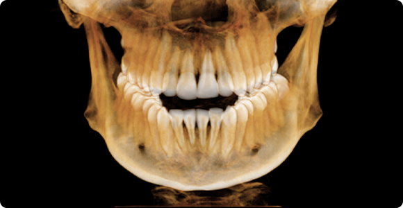 안면윤곽 재수술 후 3D CT 정면 이미지