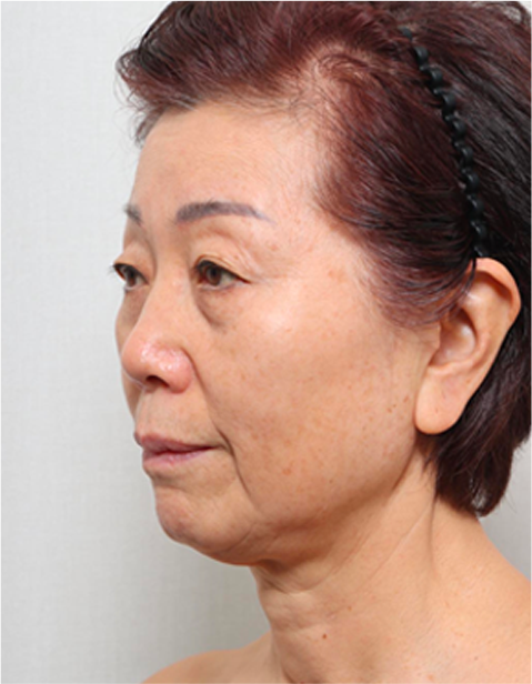안면거상 수술 전 측면 사진