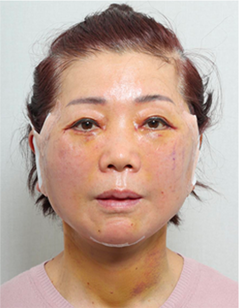 안면거상 수술 후 정면 사진