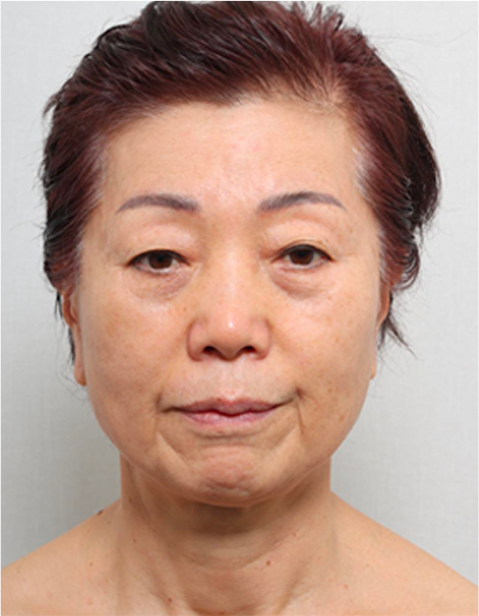 안면거상 수술 전 정면 사진