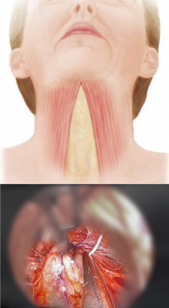 목 근육 구조와 안면거상 수술 박리 모습을 보여주는 이미지