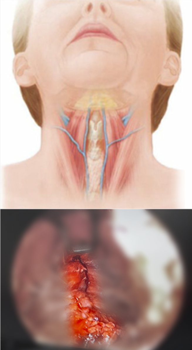 목의 해부학적 구조와 안면거상 수술 모습을 보여주는 이미지