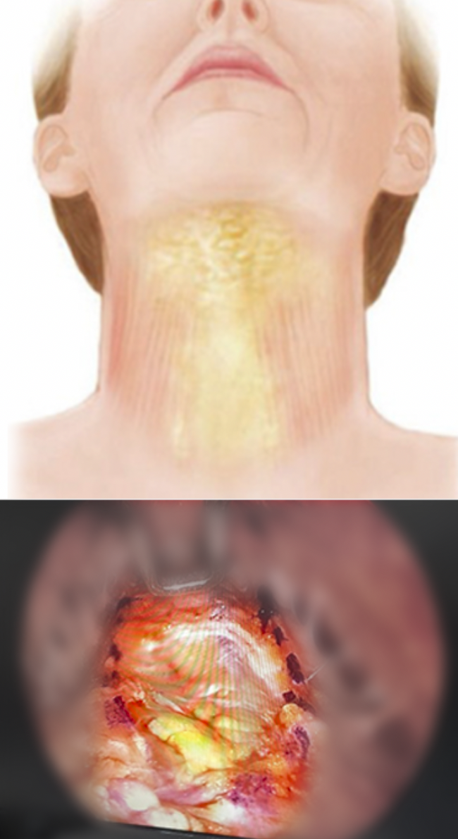 목 피부와 피하지방 및 목 근육 구조와 수술 모습을 보여주는 이미지