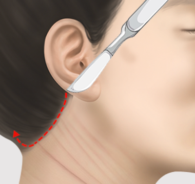 귀 뒤쪽 헤어라인을 따라 최소 절개하는 과정