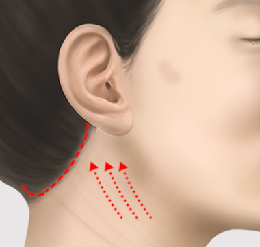 활경근을 위쪽으로 당겨 탄탄하게 고정하는 과정