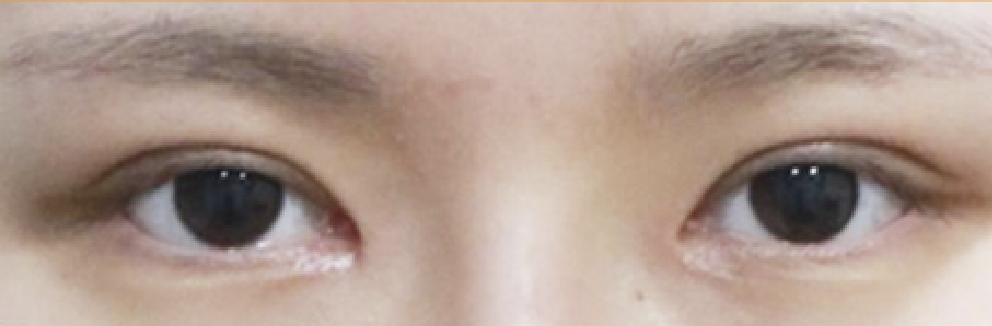 절개 눈성형 수술 1개월 후 눈을 뜬 모습 사례 1