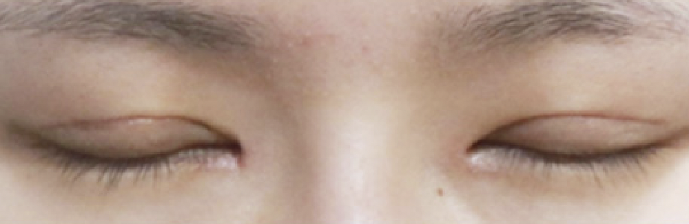 절개 눈성형 수술 1개월 후 눈을 감은 모습 사례 1