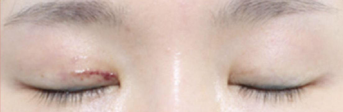짝눈교정 수술 1주 후 눈을 감은 모습